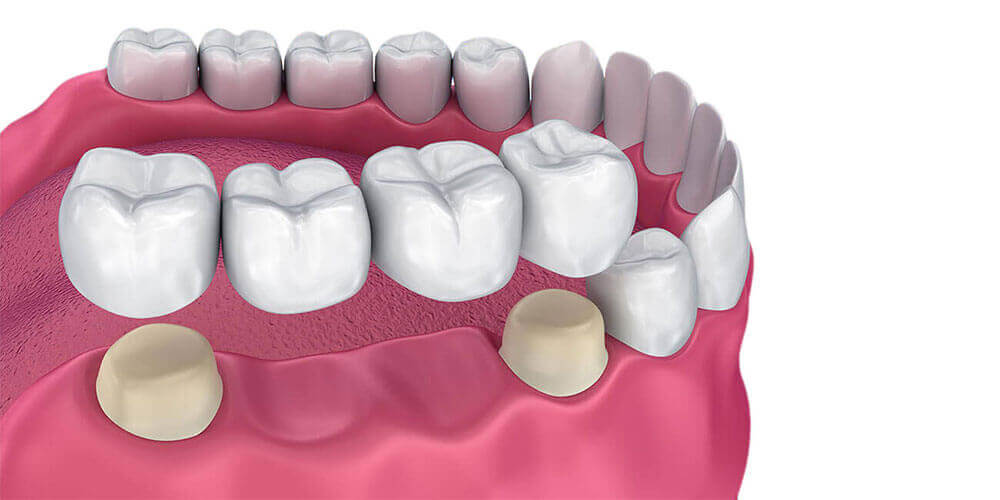 Dental Bridges Fort McMurray