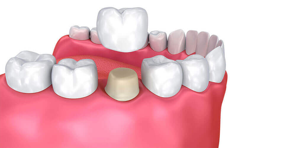 Dental Crowns Fort McMurray