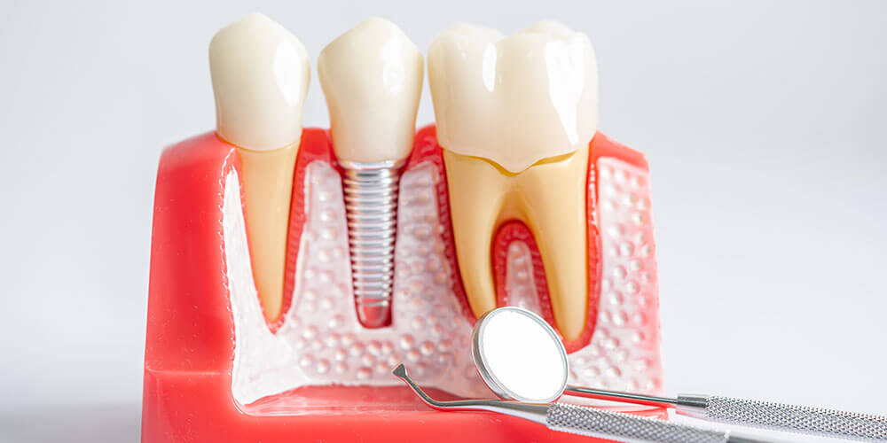 Dental Implants Fort McMurray