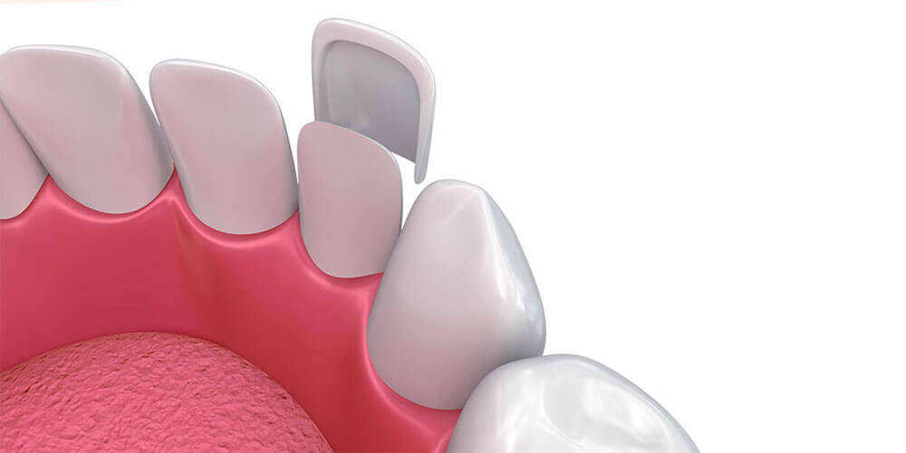 Dental Veneers Fort McMurray